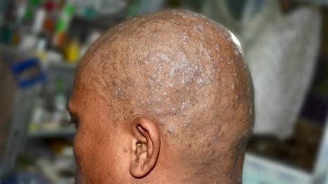 Sores On Scalp Pictures