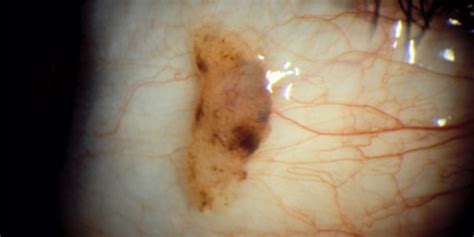 Nevus Eye Freckle American Academy Of Ophthalmology