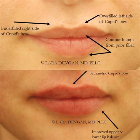 Correcting Lip Filler That Is Lumpy And Bumpy — Lara Devgan Md Mph Facs