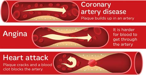 Coronary Artery Disease Cad Ischaemic Heart Disease Heart Foundation