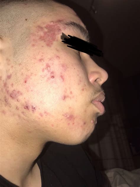 What Acne Scars Are These And What Treatments Are Best For My Scars