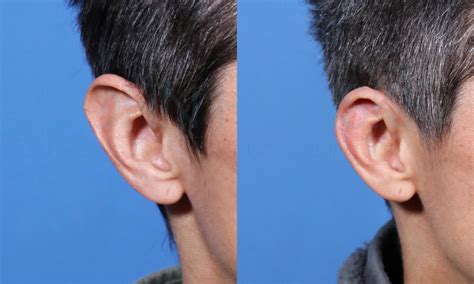 Macrotia Ear Reduction Front View Changes World Expert In Making Ears