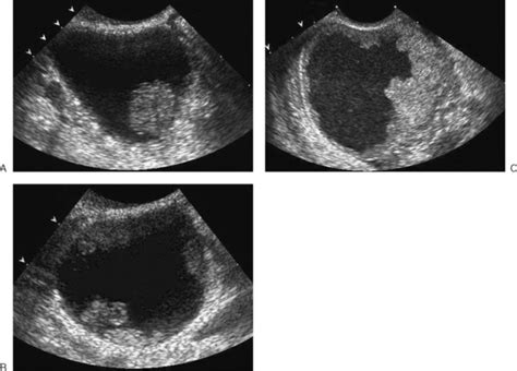 Ovarian Cancer Ultrasound