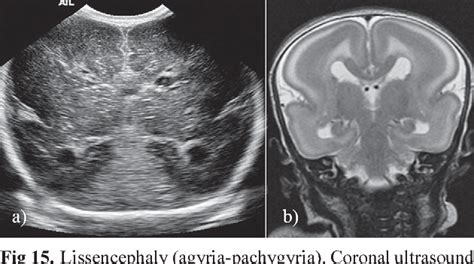 Figure 9 From Neonatal Head Ultrasound Systematic Approach To