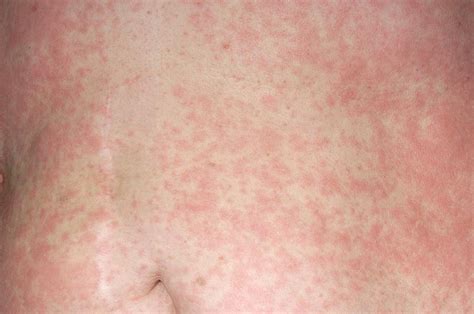 Urticaria Rash On Abdomen Photograph By Dr P Marazziscience Photo Library
