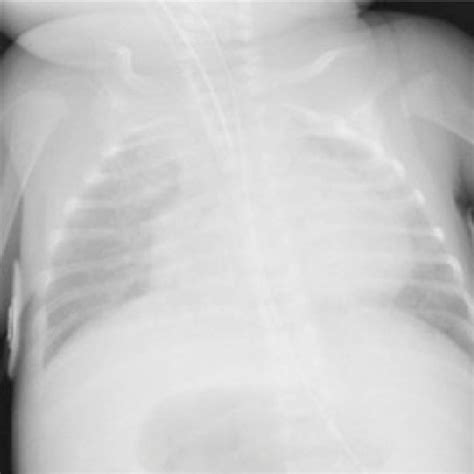 Chest X Ray Showing Cardiomegaly And Pulmonary Edema Download