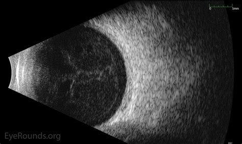 Open Globe Online Ophthalmic Atlas