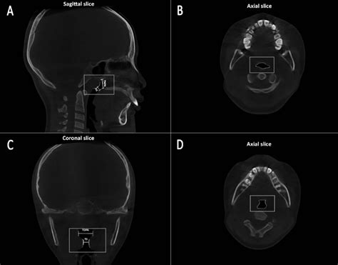 A Obstructive Adenoid Hypertrophy In The Sagittal Section B