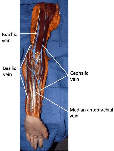 Cureus Median Cubital Vein Traveling Deep To The Bicipital