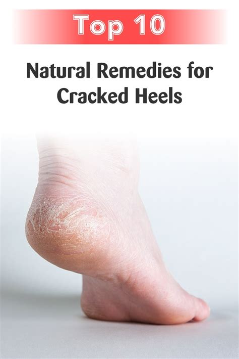 Style Craze Fitness Top 10 Natural Remedies For Cracked Heels