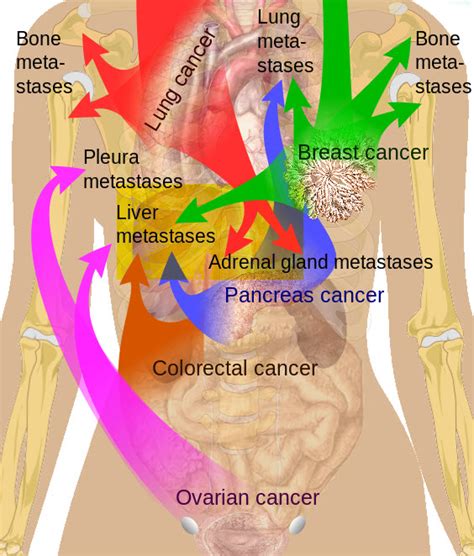 It's also referred to as advanced breast cancer. Department of Surgery - Liver Metastases