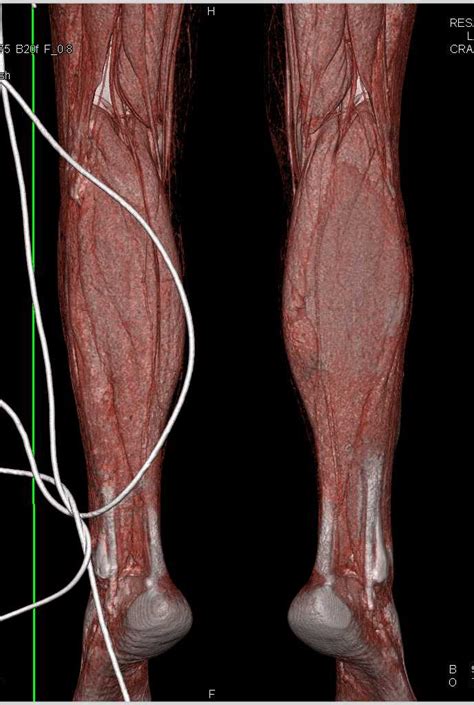 Trauma To The Left Calf Musculoskeletal Case Studies Ctisus Ct Scanning
