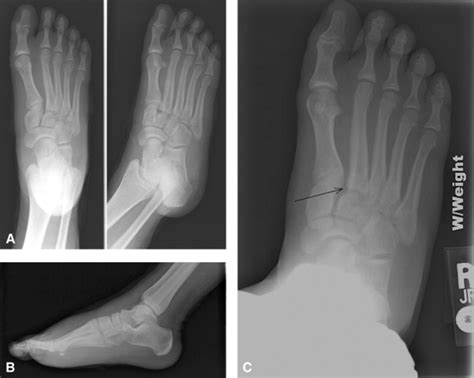 The injury is named after jacques lisfranc de st. David Lewis | Department of Emergency Medicine | Saint ...