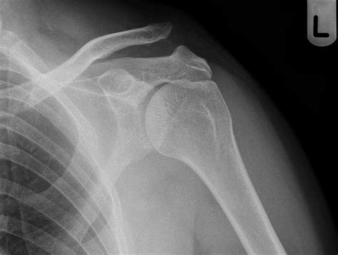 Dislocation Of The Acromial End Of The Clavicle Medclinic