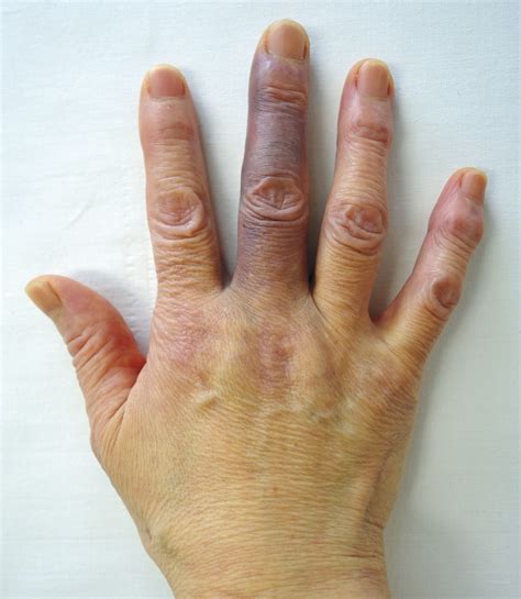 The impact it the injured finger causes bleeding under the skin. Achenbach's Syndrome | NEJM