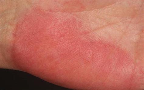 Palmar Erythema Symmetrical Reddening Of The Palms Causes And Treatment
