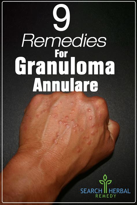 Since it's not contagious, you can leave it alone until it clears. 9 Natural Treatments For Granuloma Annulare - How To Treat ...