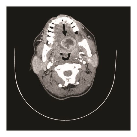 Contrast Enhanced Ct Scan Demonstrated An Abscess At Left Posterior