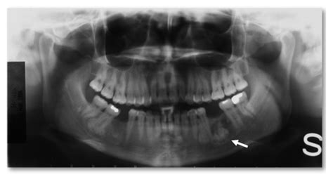 Jcm Free Full Text Craniofacial Osteomas From Diagnosis To Therapy