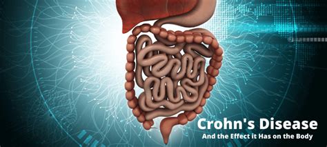 Crohns Disease And The Effect It Has On The Body Spoke Research