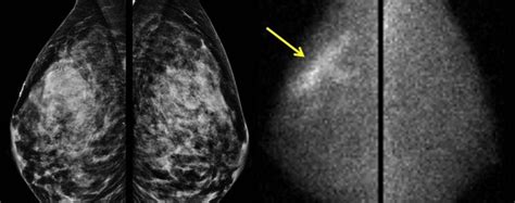 New Screening Tests For Hard To Spot Breast Cancers Wsj