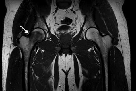 A Thirty One Year Old Man With Acute Right Hip Pain Jbjs Image Quiz