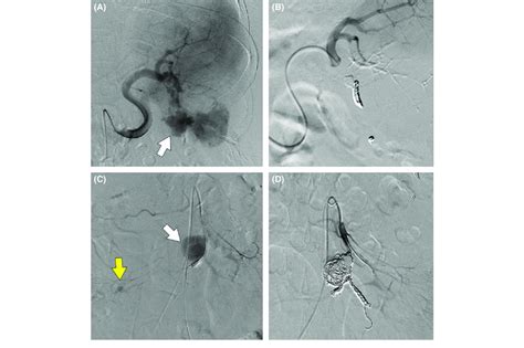 Angiogram And Transcatheter Arterial Embolization A Splenic Artery