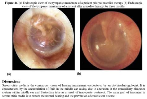 Ambroxol For Otitis Media Ear Infection In Rats Oc Dumbos