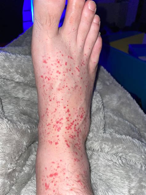 A Lot Of Red Spots On Feet Anyone Know What This Might Be I Have Them Going Up My Leg But It