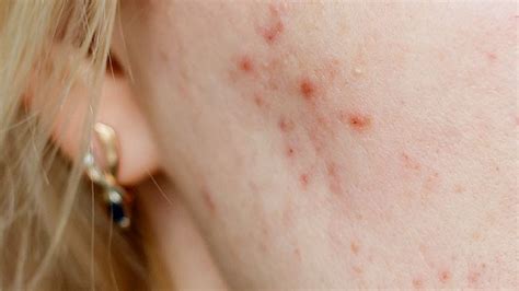 Red Acne Scars