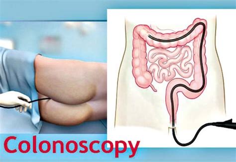 It is recommended that people of average risk get a colonoscopy or other type of screening every 10. Understanding Colonoscopy | BusinessMirror