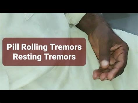 Resting Tremors In Parkinson S Disease YouTube