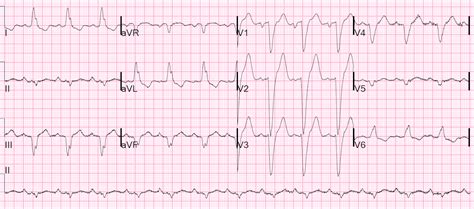 Dr Smith S ECG Blog Left Bundle Branch Block Severe Chest Pain Previous Normal Angio What