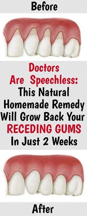 Grow Back Your Receding Gums In 2 Weeks By Only Using These Natural