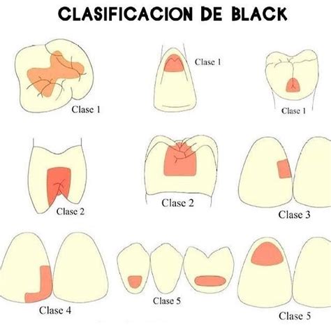 Las Cinco Clases De Cavidades Dentales Según Black Son 1️⃣clase I Molar O Premolar