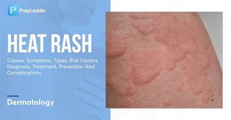 Heat Rash Causes Symptoms Types Risk Factors Diagnosis Treatment Prevention And Complications