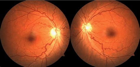 Fundus Photographs Showing Veins Are Convoluted And Slightly Dilated