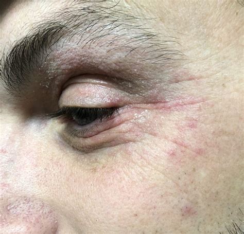 Periorbital Dermatitis Eyes