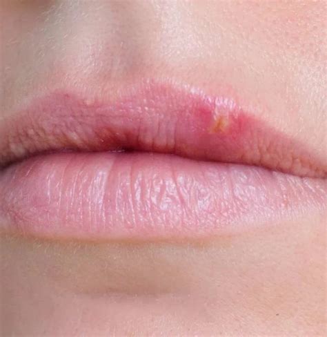 Bump On Lip Causes Treatment And When To See A Doctor Swollen Lip My