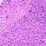 Sheets Of Epithelioid Histiocytes With Large Vesicular Yet 