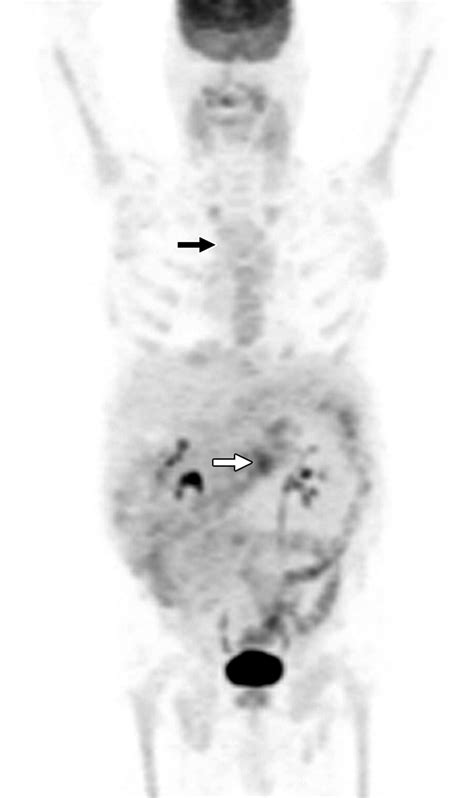 Clinical Utility Of Petct In Lymphoma Ajr