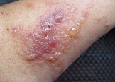 Control de Plagas en Sanidad Ambiental: Dermatitis por contacto con ...