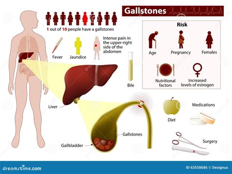 Gallstones Медицинское Infographic Иллюстрация вектора иллюстрации