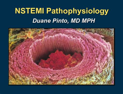 This results in one of the unhealthiest scenarios that you could. Acute Coronary Syndromes: NSTEMI | tctmd.com