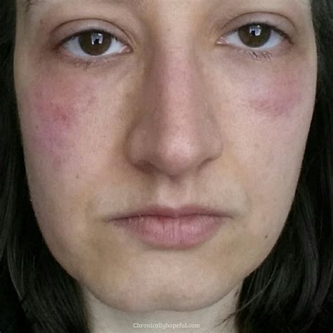 Histamine Intolerance How Im Reducing My Rashes And Hives Face
