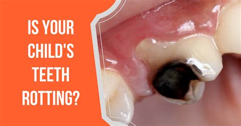 What To Do If My Childs Teeth Are Rotting Expert Dental Care