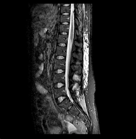 Sagittal T2 Weighted Mri Image Showing Regression Of The Conus