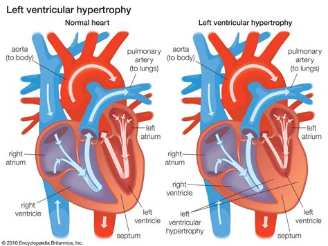 Hypertrophy Of The Heart