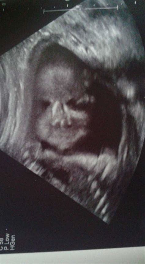30 Creepy Ultrasound Pictures That Will Make You Question Having