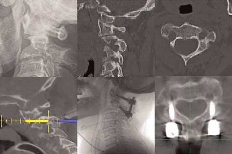 Bicortical Short C2 Pars Screw Fixation For High Riding Vert Spine